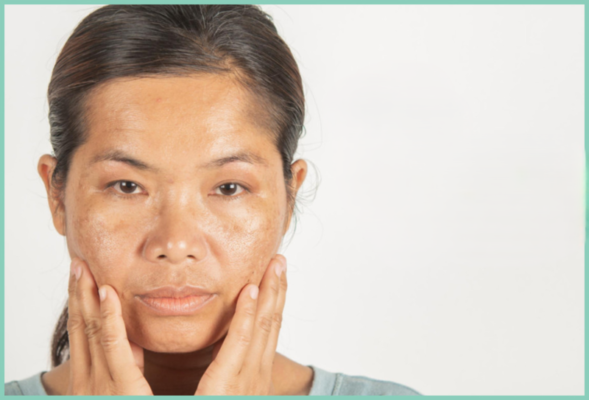 Cách chăm sóc da bị nám chân sâu phổ biến