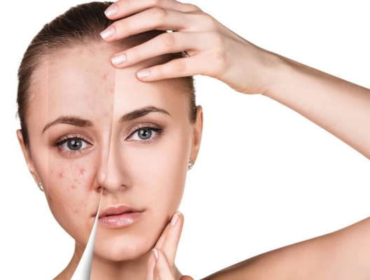 5 cách chăm sóc da mặt mụn thâm đúng cách