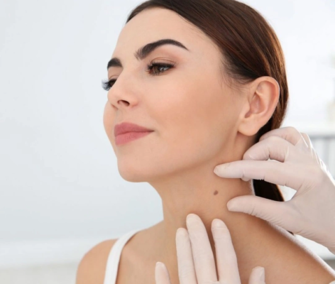 Cách chăm sóc da sau khi đốt mụn thịt như thế nào?